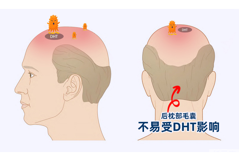 植发，为什么只能在后脑勺取发? 图片-2