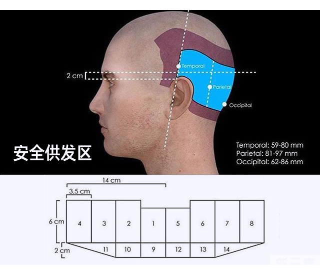 植发，为什么只能在后脑勺取发? 图片-4