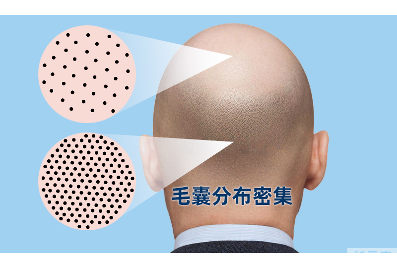 植发，为什么只能在后脑勺取发? 图片-5