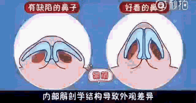 追求5分到9分的颜值飞跃，有效隆鼻很关键! 图片-7