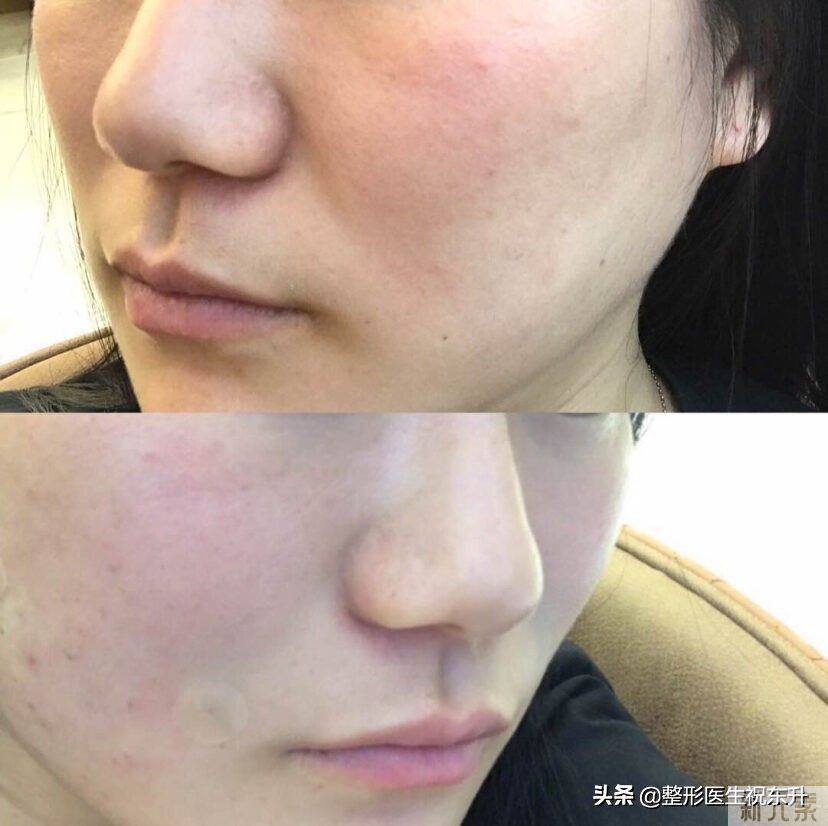 脸上有了法令纹?消除真的不难，这“3个方法”实用又有效 图片-4