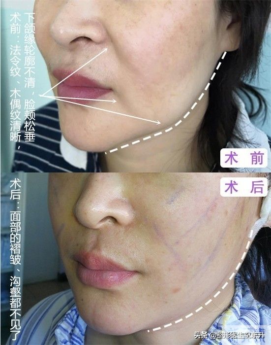 脸上有了法令纹?消除真的不难，这“3个方法”实用又有效 图片-5
