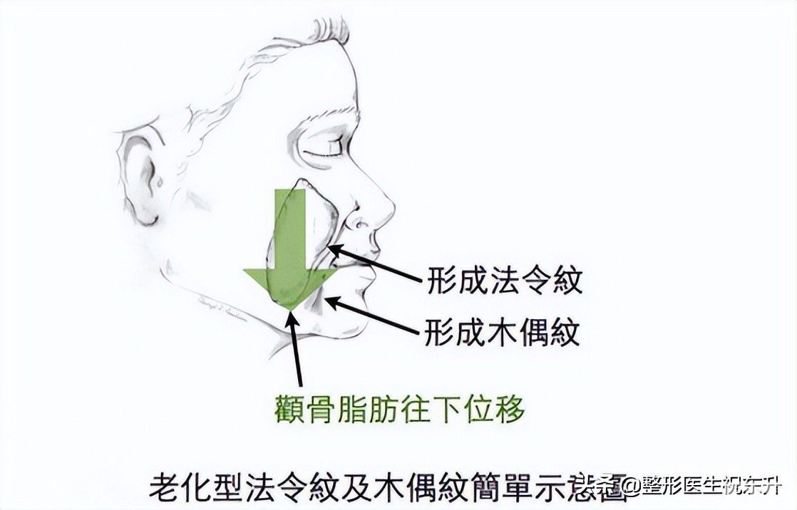 脸上有了法令纹?消除真的不难，这“3个方法”实用又有效 图片-3