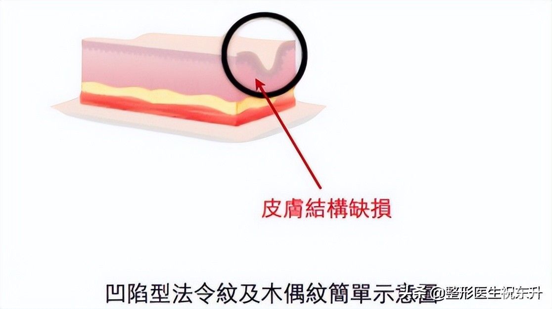 脸上有了法令纹?消除真的不难，这“3个方法”实用又有效 图片-2