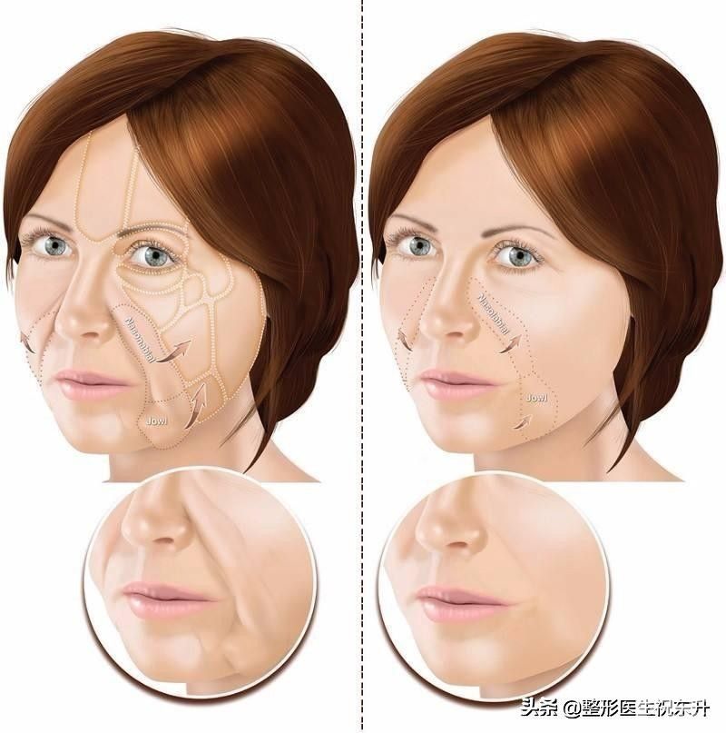 脸上有了法令纹?消除真的不难，这“3个方法”实用又有效 图片-6