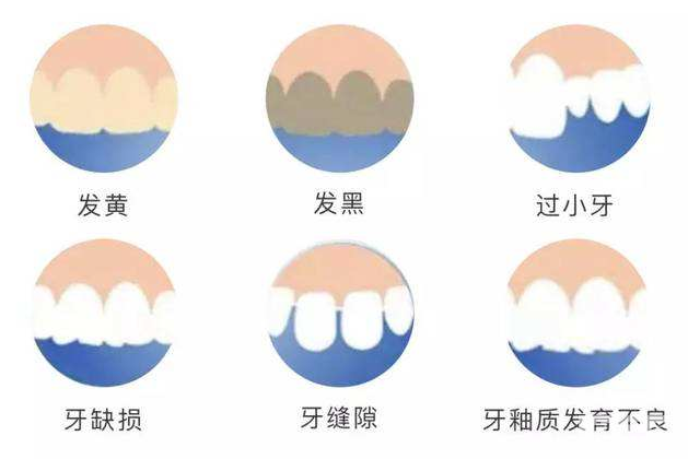 牙齿美白贴面，让你“武装到牙齿”! 图片-9