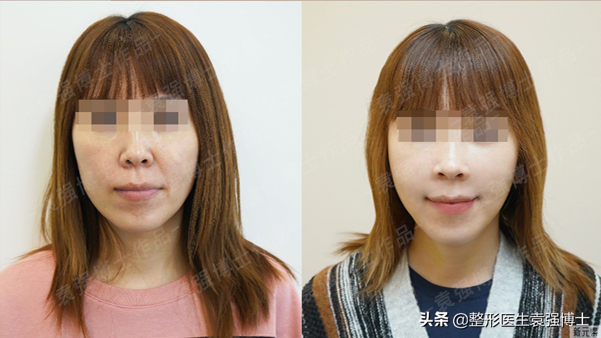 43岁做完拉皮10天了，公开手术过程和恢复期一些真实感受 图片-5