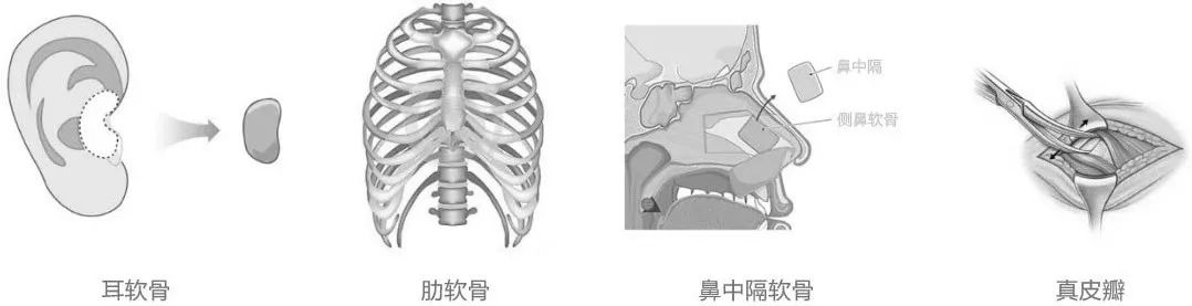 隆鼻能管一辈子吗?为什么有的人要修复? 图片-3