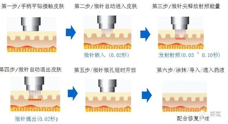 被毛孔和痘疤侵占的皮肤如何重返细腻?医生说这件闪着金光的神器很有效 图片-4