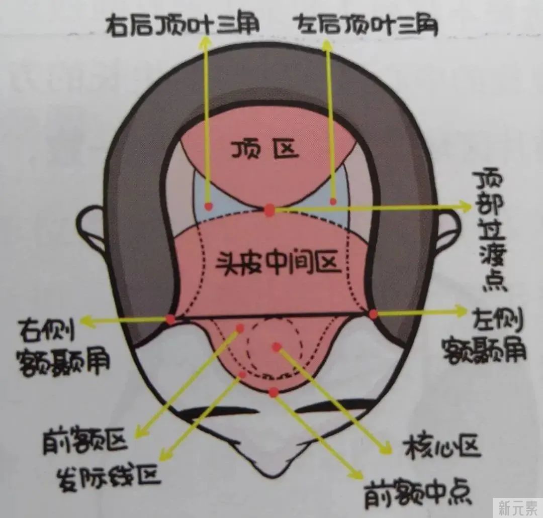 脱发面积大到整个头顶都没头发，还可以植发吗? 图片-7