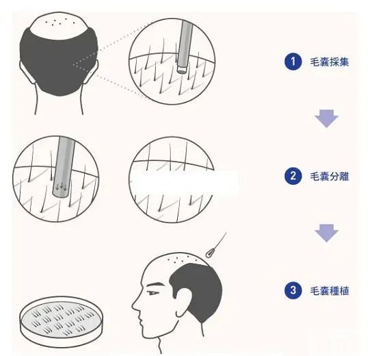 脱发面积大到整个头顶都没头发，还可以植发吗? 图片-9