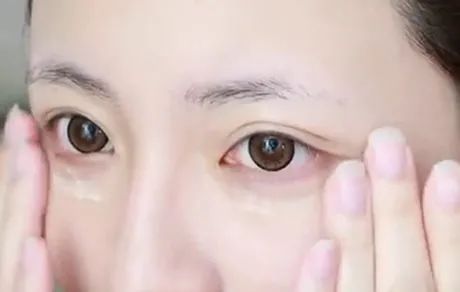 原来眼袋也有好几种，你还不清楚自己属于哪种类型? 图片-10