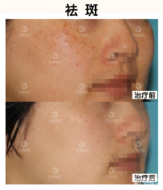 【医美科普】想要美白的请看这里! 图片-5