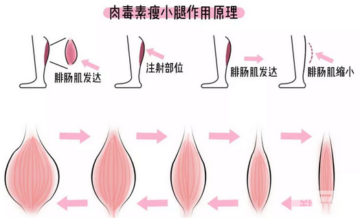 瘦腿针打多久能见效?可以维持多久?你想知道的都在这! 图片-7