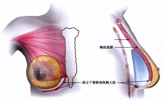 想做假体隆胸，假体从哪植入最自然? 图片-5