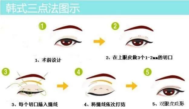 你担心的双眼皮问题，这里都有解答哦 图片-9