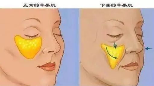 一条纹老十岁!颜值克星「法令纹」怎么去除? 图片-12