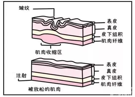 一条纹老十岁!颜值克星「法令纹」怎么去除? 图片-11