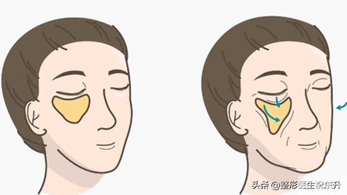 你是什么类型的法令纹，就用什么方法去除 图片-3