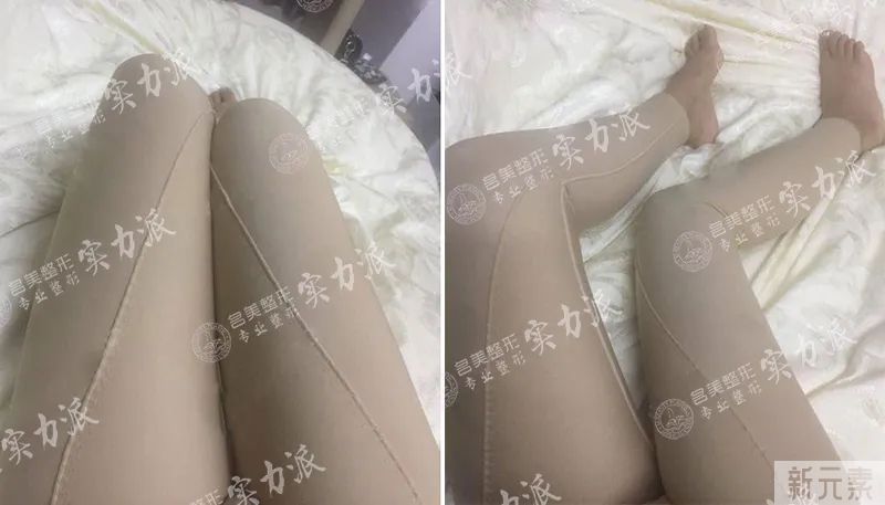 假胯宽，吸脂还能增高?瘦腿又长高？ 图片-16