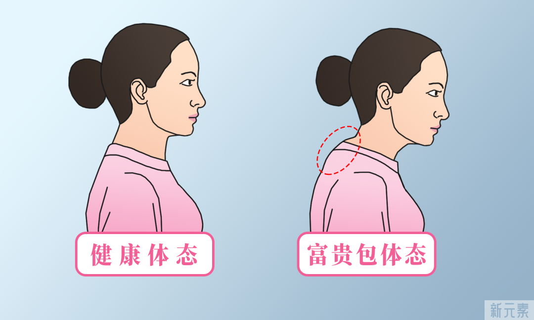 有钱人才会长“富贵包”?那不是富贵，是疾病! 图片-3