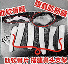 ​做耳软骨隆鼻你在担心什么? 图片-4
