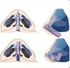 ​做耳软骨隆鼻你在担心什么? 图片-5
