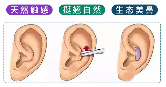 ​做耳软骨隆鼻你在担心什么? 图片-6