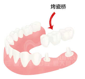拔牙后不处理真的好吗? 图片-7