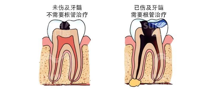 根管治疗后，牙齿还能用多久? 图片-4