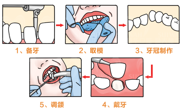 根管治疗后，牙齿还能用多久? 图片-6