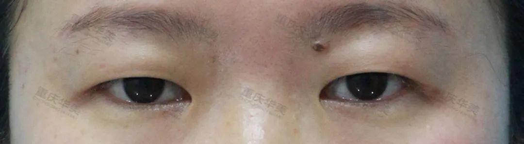原来双眼皮手术的价格是这样算的? 图片-7