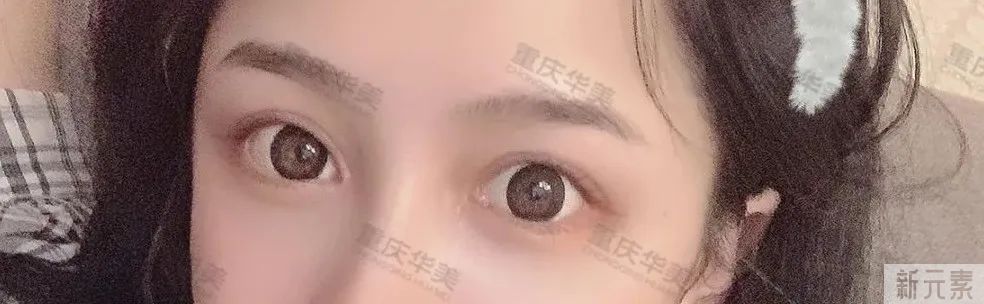 原来双眼皮手术的价格是这样算的? 图片-8