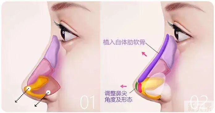 隆鼻全肋or半肋，哪款适合你? 图片-4