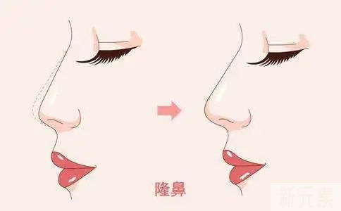 隆鼻全肋or半肋，哪款适合你? 图片-1