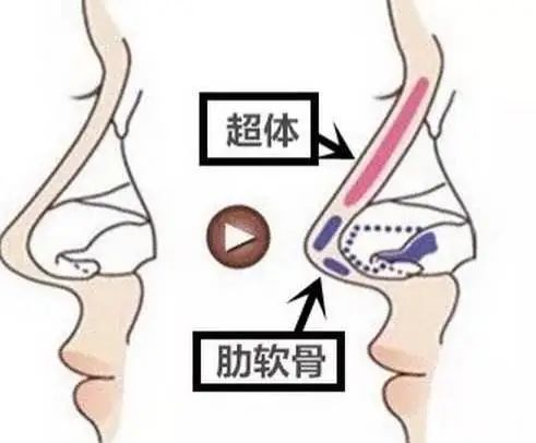 隆鼻全肋or半肋，哪款适合你? 图片-3