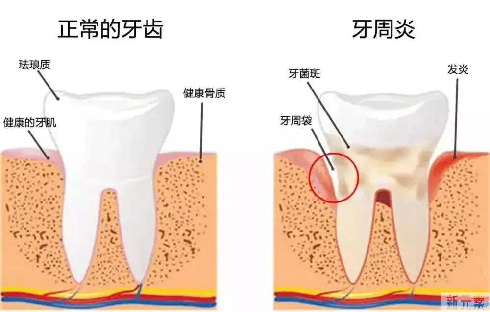 缺牙多年，还能种牙吗? 图片-10