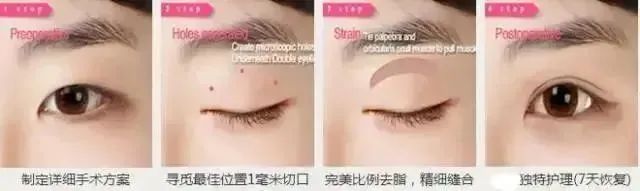 【干货】你适合什么样的双眼皮? 图片-9
