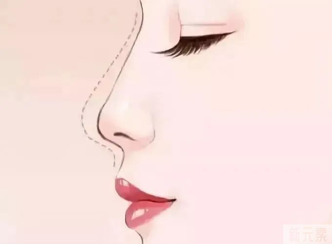 刷爆朋友圈的线雕提升，真的有这么神奇吗? 图片-3