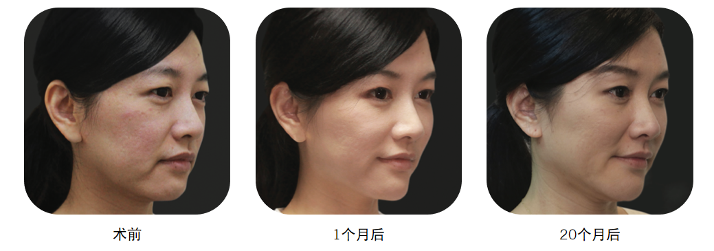 雅涵“少女针”——领取你的“针”爱 图片-14