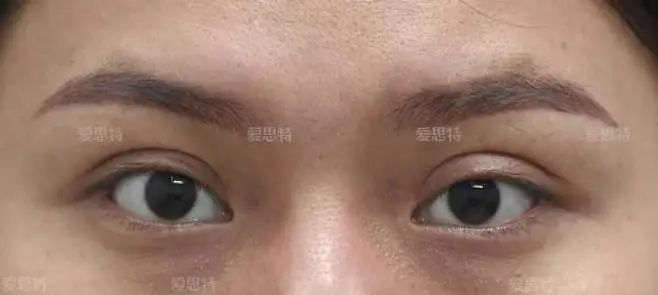 双眼皮太宽、太假、不对称，居然修复成了这样!! 图片-2