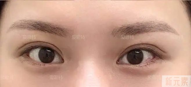 双眼皮太宽、太假、不对称，居然修复成了这样!! 图片-3