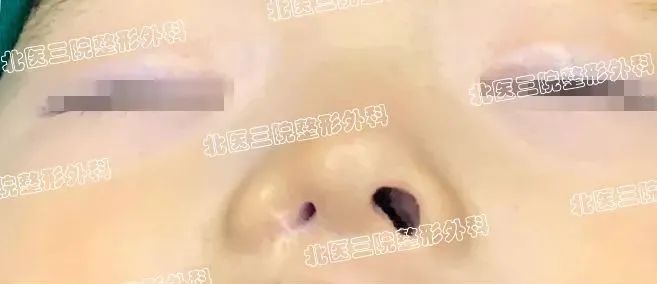 鼻畸形之鼻孔闭锁或狭窄 图片-1