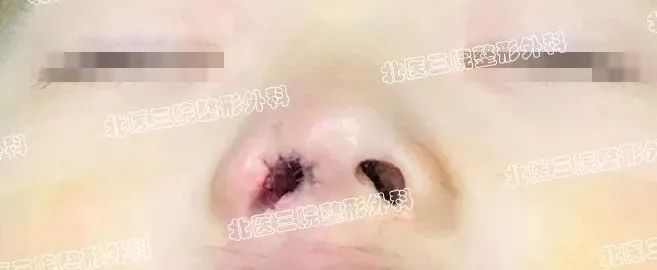 鼻畸形之鼻孔闭锁或狭窄 图片-2