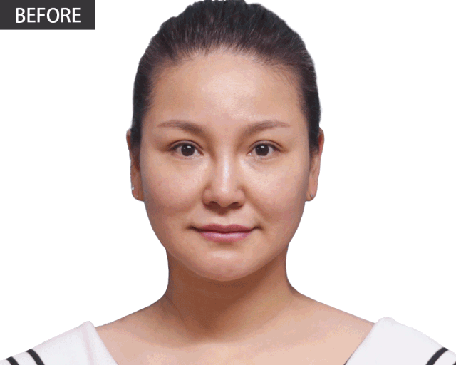 沈阳杏林整形除皱案例 | 这个立竿见影的抗衰手术，胜在哪里? 图片-2