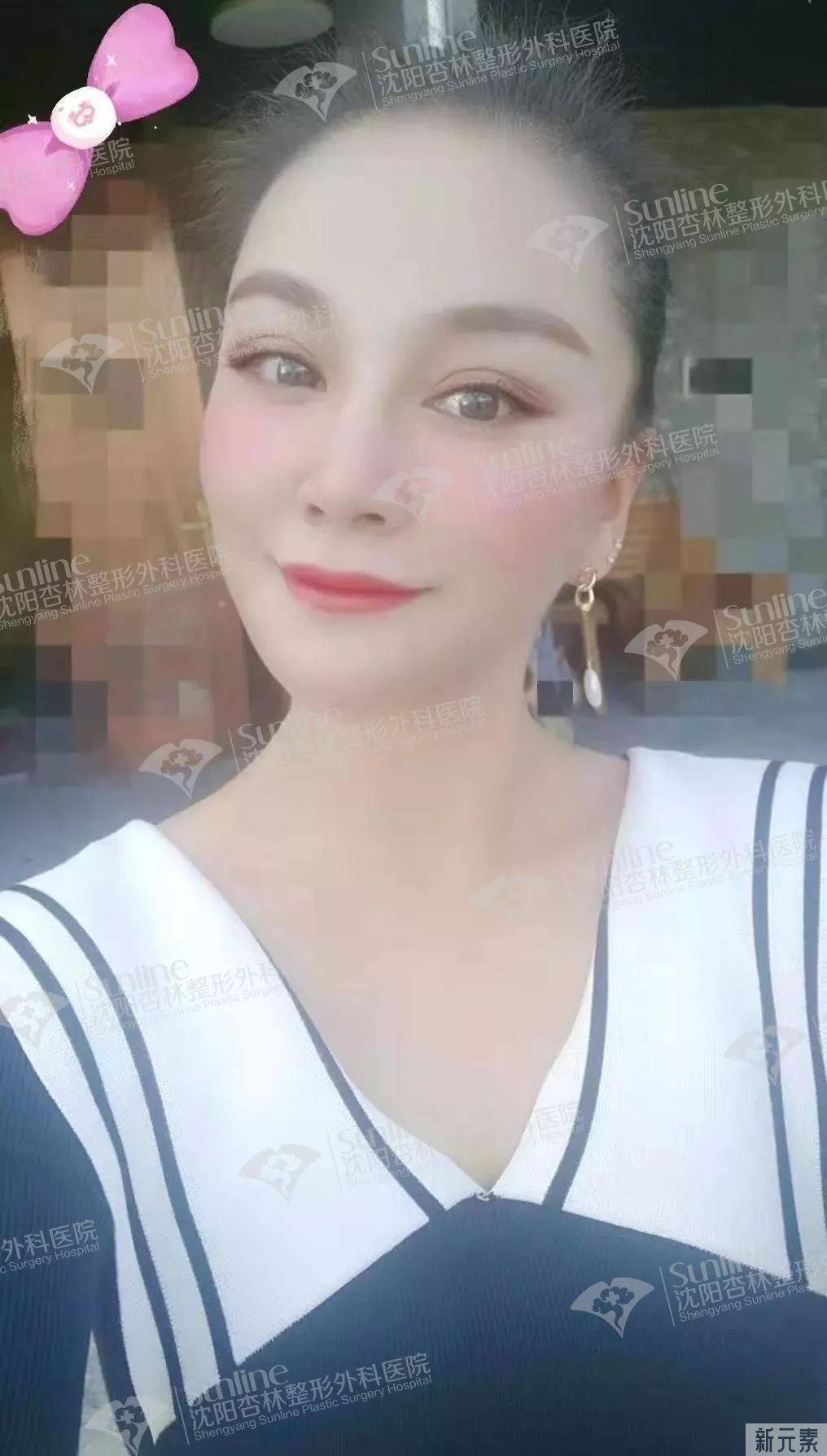 沈阳杏林整形除皱案例 | 这个立竿见影的抗衰手术，胜在哪里? 图片-8
