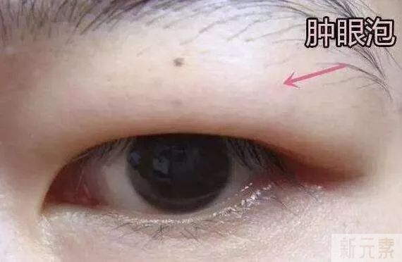 割完双眼皮，去掉的脂肪会继续长出来吗? 图片-3