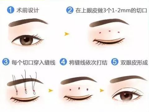 都是同一天做的双眼皮，为啥她恢复这么快? 图片-6
