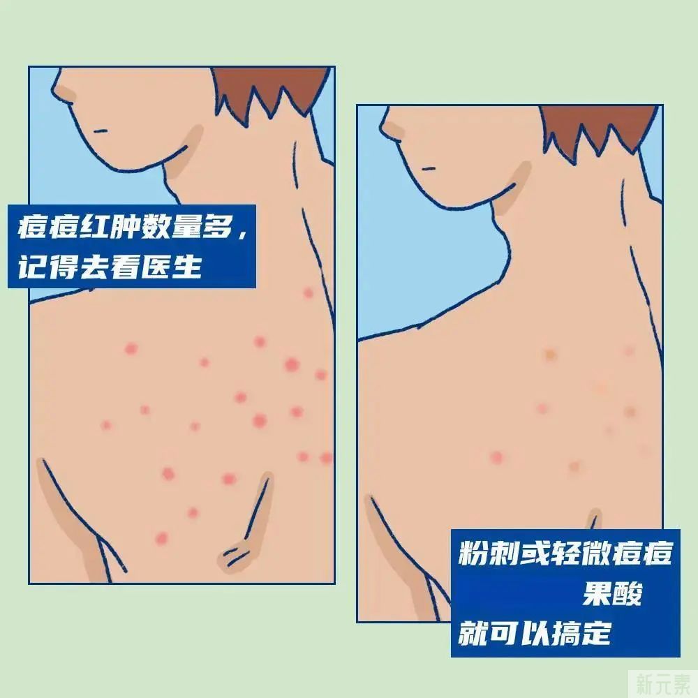 后背长痘可以刷酸吗?用什么酸呢 图片-4