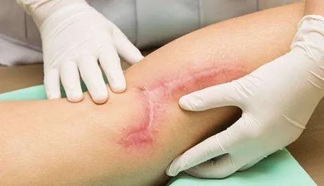 10多年凹凸不平的老疤能修复到什么程度?能和原来肌肤一样吗? 图片-6